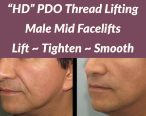 PDO Male Lift and Tighten